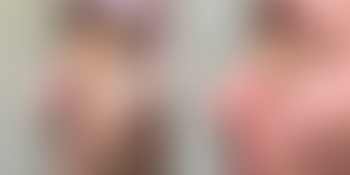 Male rhinoplasty by Dr. Azzi - profile view