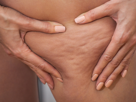 Can Belkyra Treatment help with cellulite?