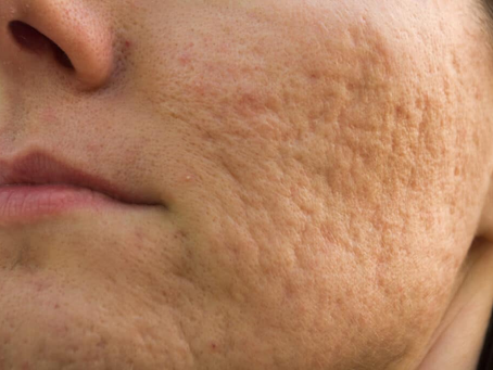 Can Scar Laser Treatment treat acne scars?