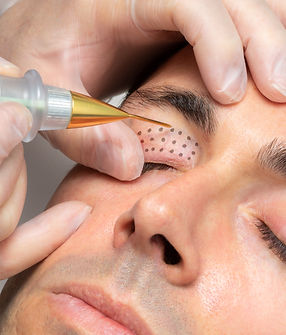 Close up macro detail of middle aged man having skin tightening on eyelids with laser plas