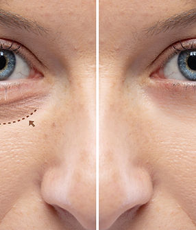 Before and after a rejuvination treatment, wrinkles and crow's feet removal Lines and arro