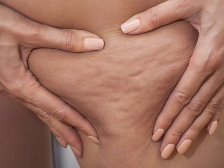 La cellulite: un disturbo comune, ma non solo estetico