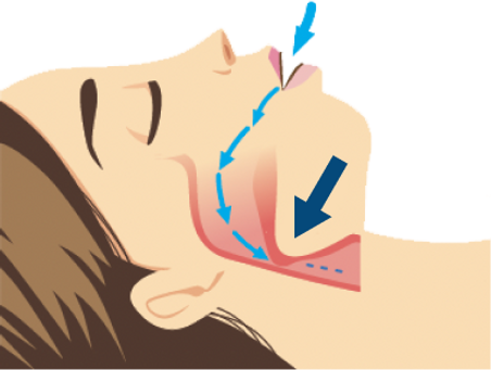 without snore cure.png