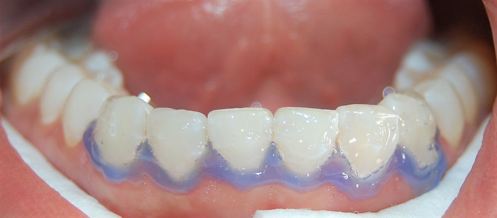 Protector de encías