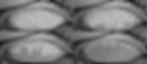 Meibomian+Gland+scale_edited.jpg