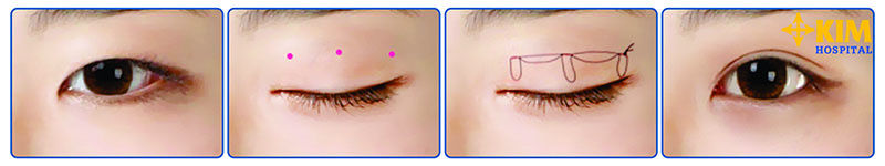 Chi phí bấm mí mắt Dove Eyes giá bao nhiêu?