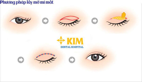 Phẫu thuật lấy mỡ mí mắt hết bao nhiêu?