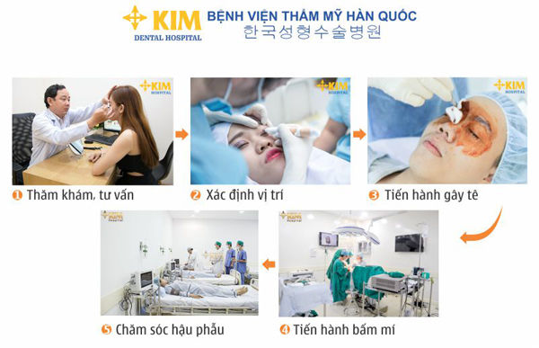 Bấm mí mắt Hàn Quốc