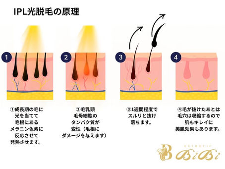 IPL光脱毛のメリット