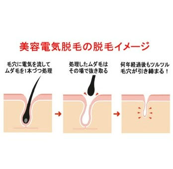 電気脱毛について♪