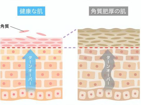角質ケア