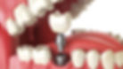 dental implants.jpg