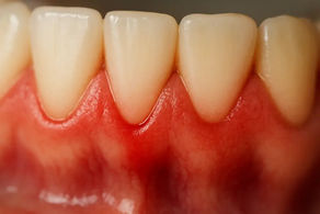 LES SIGNES D’UNE MALADIE DES GENCIVES À NE PAS IGNORER