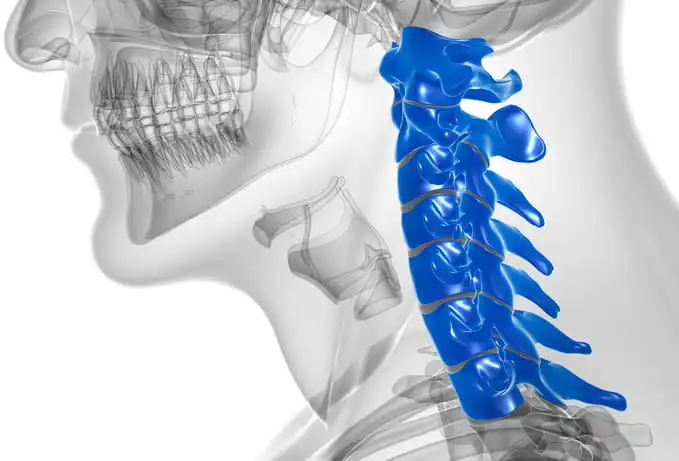 neck pain