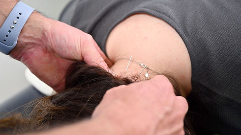 A patient receiving acupuncture treatment on their neck.