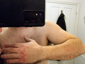 World Psoriasis Day Is on Thursday: Add One Photo to PSOR Perspective