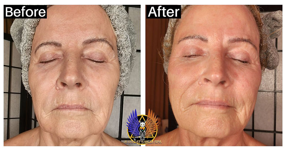 Before and After Jessicat's Medi Spa Skin Tightening and Lifting Treatments