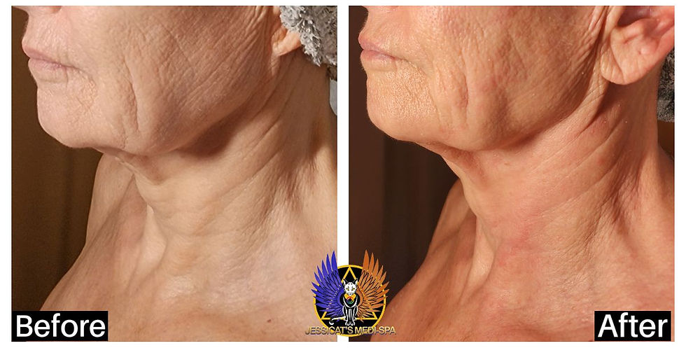 Before and After Jessicat's Medi Spa Skin Tightening and Lifting Treatments
