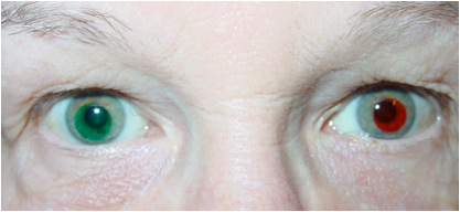 Chromagen Contact Lens