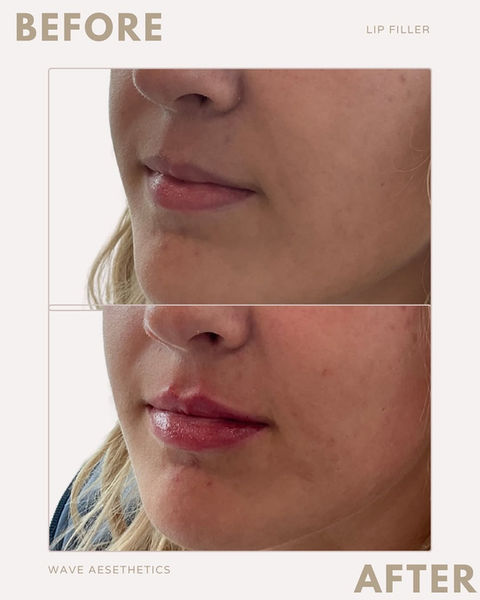 Best Lip Filler Near Me NC