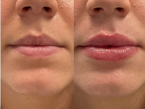  who provide the best lip fillers near me in Wilmington 