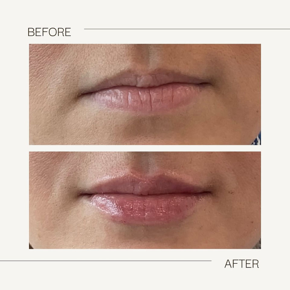 Affordable Signature Lip Filler near me Wilmington NC
