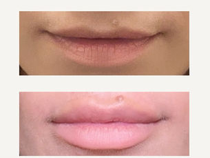 Before / After Lip Fillers