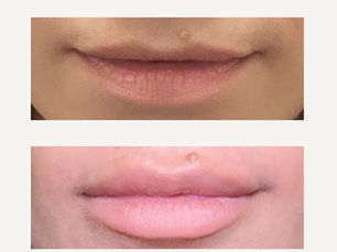 Before / After Lip Fillers
