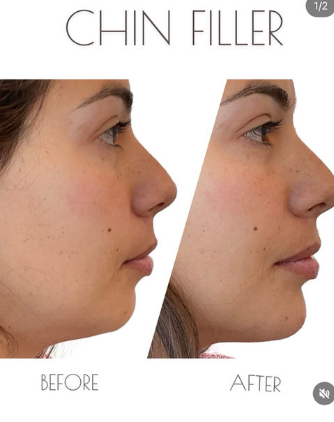 Affordable Price on Chin Filler in Wilmington NC