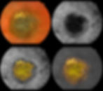 Choroidal Nevus I VRM Toronto