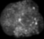 Proliferative Diabetic Retinopathy