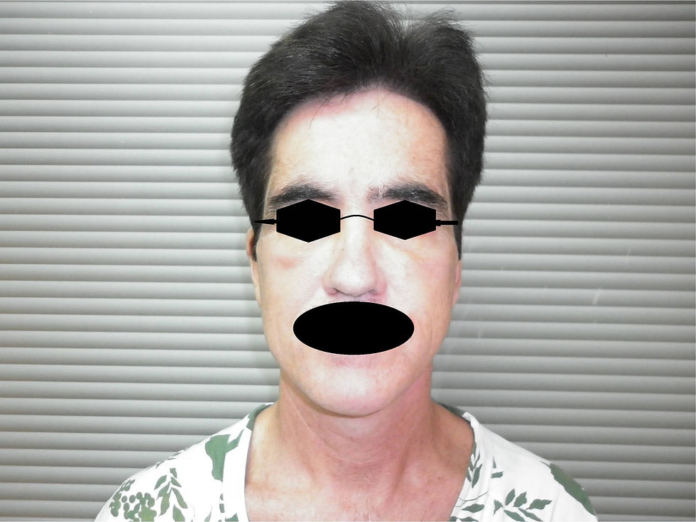 Autologous Fat Graft 6
