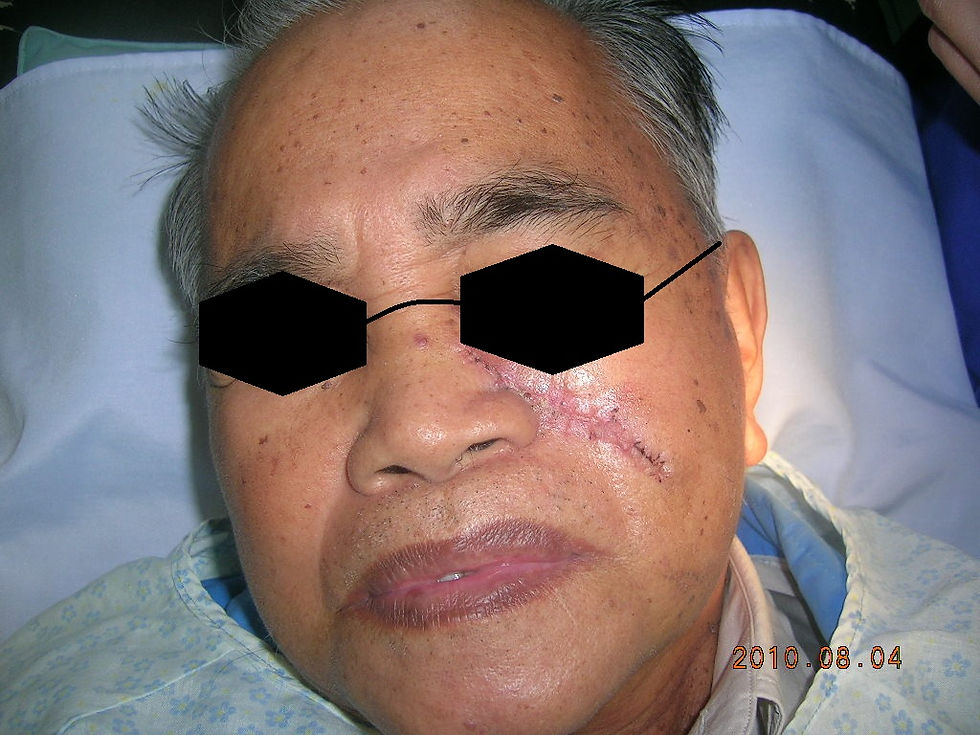 5 days post op