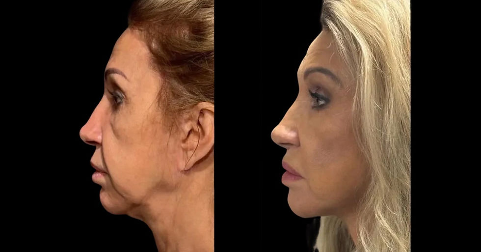 Carmen Geiss before and after facelift surgery showing dramatic facial rejuvenation with tighter jawline and neck – celebrity facelift transformation results