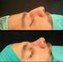 Nasenprofil eines männlichen Patienten vor und nach der Rhinoplastik-Operation auf dem Operationstisch mit Nasenrückenreduktion und verfeinerte Nasenspitze – Rhinoplastik-Operation in Istanbul, Türkei