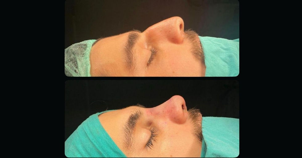 Nasenprofil eines männlichen Patienten vor und nach der Rhinoplastik-Operation auf dem Operationstisch mit Nasenrückenreduktion und verfeinerte Nasenspitze – Rhinoplastik-Operation in Istanbul, Türkei