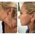 Pacientă reală înainte și după operația de lifting facial și cervical arătând o transformare dramatică cu pielea gâtului mai fermă și linie a maxilarului definită – rezultate lifting facial înainte și după în Istanbul, Turcia