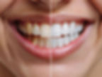 Before and after teeth whitening treatment results showing dramatic transformation from stained yellow teeth to bright white smile – dental aesthetic treatment in Istanbul Turkey