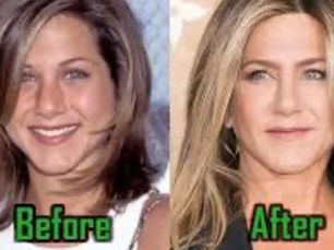 Jennifer Aniston Rhinoplastik vor und nach Gesichtstransformation zeigt subtile Nasenformung über die Jahre – ikonische Prominenten-Nasenoperation und Schönheitsoperationsreise