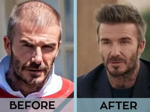 David Beckham Haartransplantation vor und nach zeigt Kopfhautausdünnung versus wiederhergestelltes volles Haar – Ergebnisse der Haarwiederherstellungsoperation eines berühmten Prominenten
