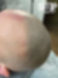 hair implant Vancouver