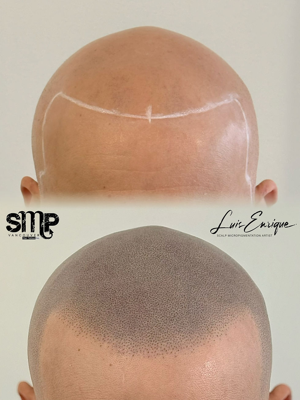hair tattoo in vancouver, hair restoration 
