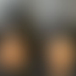 Where to Find Thinning Hair SMP Treatments in Vancouver?