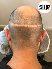 Hair Transplant Scar
