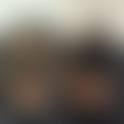 SMP vs Hair Transplants in BC: What Results Look Like After 5+ Years