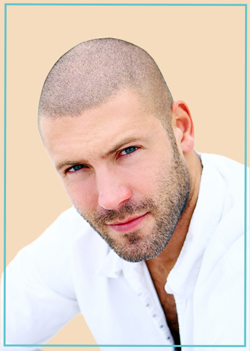 Süleyman Taş Yorumlar Things to Know Before Hair Transplant