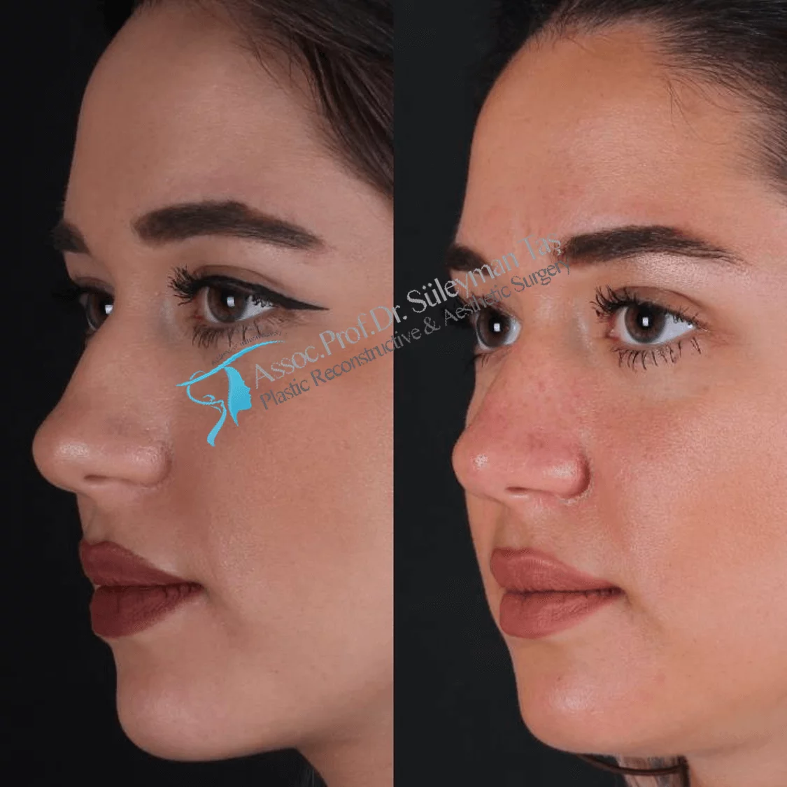 Suleyman Tas Before After Rhinoplasty
