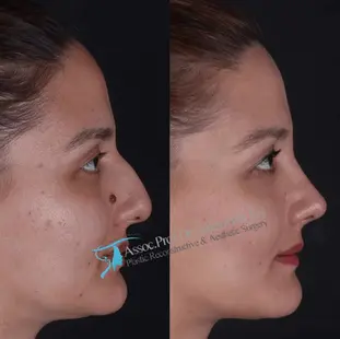 Suleyman Tas ultrasonic rhinoplasty results