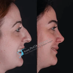 Suleyman Tas facial harmony rhinoplasty