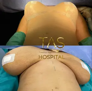Case Study – Breast reduction & Lift